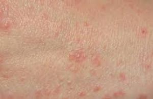 Acaip denuncia un aumento de casos de sarna en las c&aacute;rceles espa&ntilde;olas: de 58 a 176 en cinco a&ntilde;os